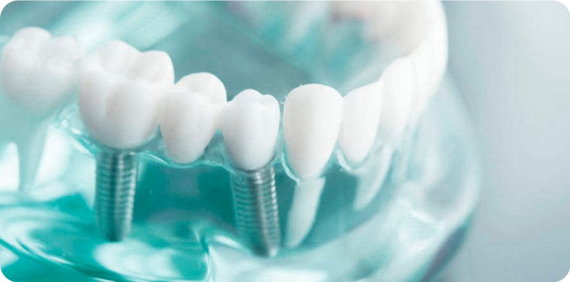 implantes dentales las rozas implantes dentales las rozas