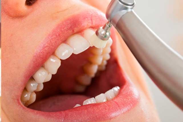 Blanqueamiento dental, cuando realizarnos el tratamiento