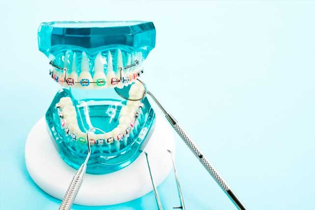 Brackets: la mejor solución