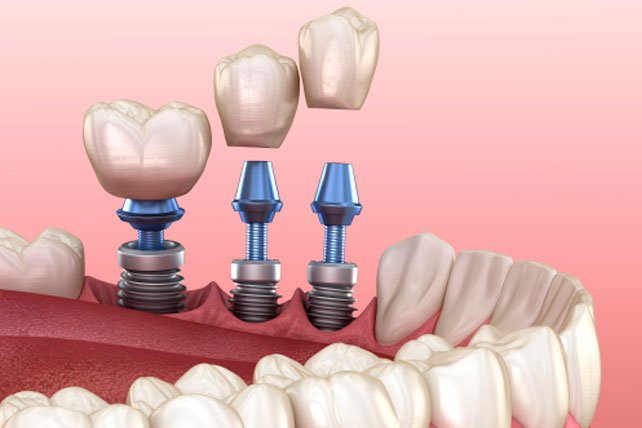 ¿Qué es la cirugía de implantes dentales?