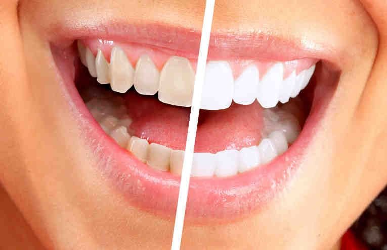 Blanqueamiento dental