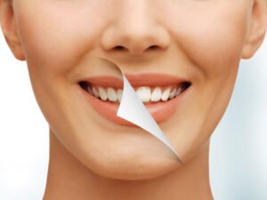 Conoce como mantener el blanqueamiento dental